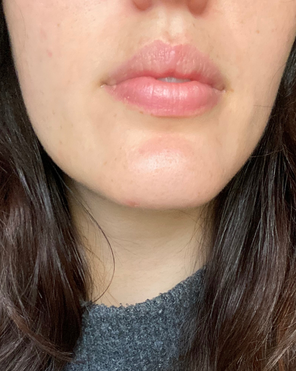 After photo of Bianca V. Month 3