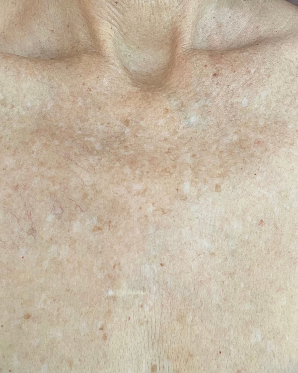 After photo of Nancy Week 2