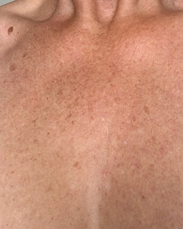 Before photo of Toni Before application