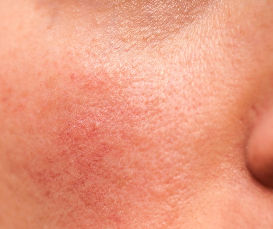 Couperose Skin Vs. Rosacea: What's the Difference? - Mukti Organics