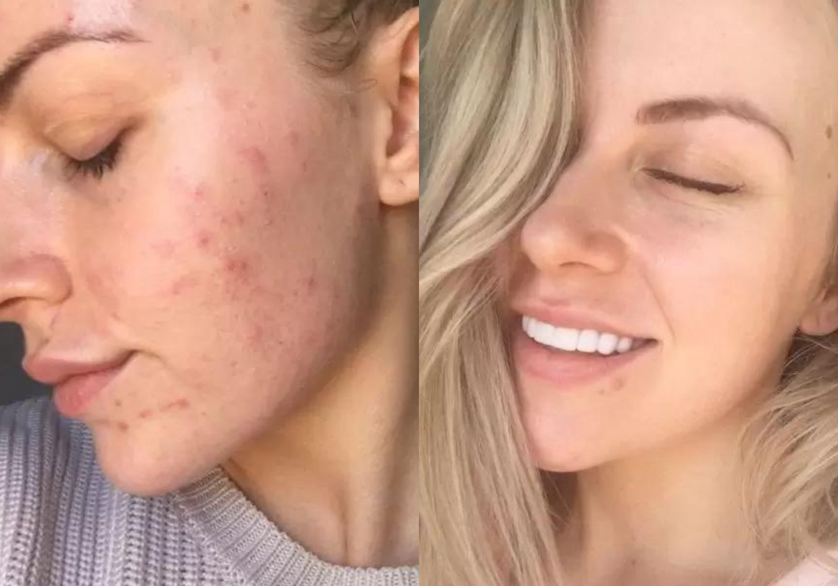 Vitamin C Serum Before After: Stunning Transformations
