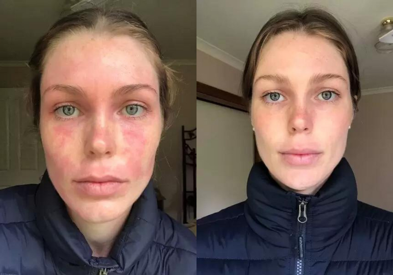 Before-and-after photo of a woman's face showing a reduction in eczema after using a natural skincare treatment