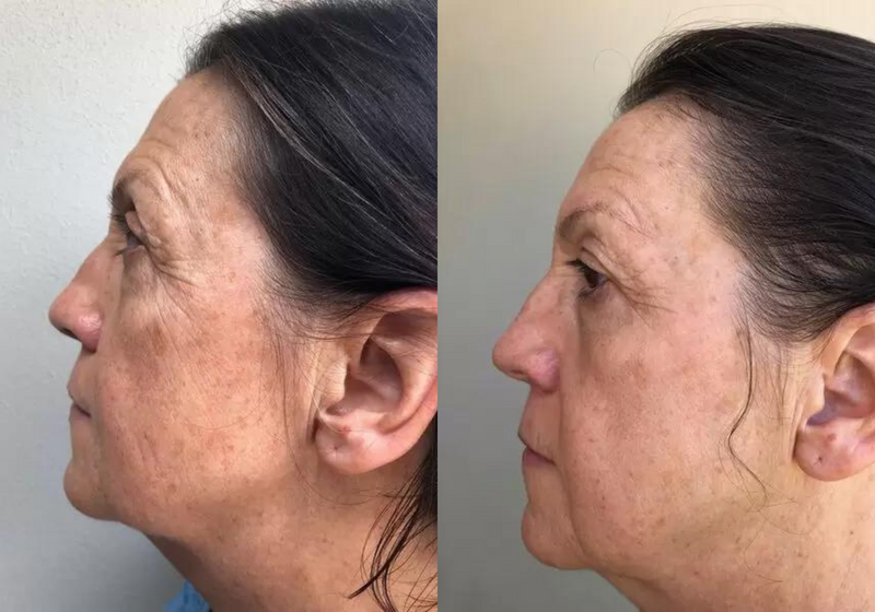 Before-and-after photo of a woman's face showing improvement in skin tone and reduction in blemishes after using a natural Vitamin C skincare treatment