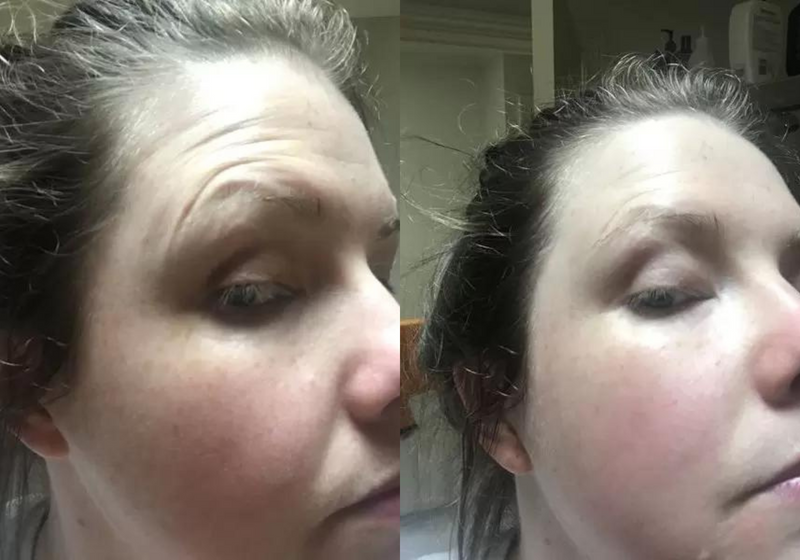 Before-and-after photo of a woman's face showing a reduction in wrinkles after using a natural anti-aging skincare treatment