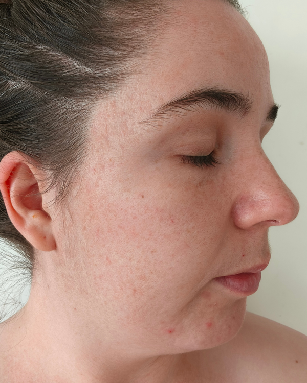 Before photo of Chloe Before