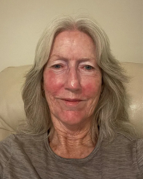 After photo of Frances After
