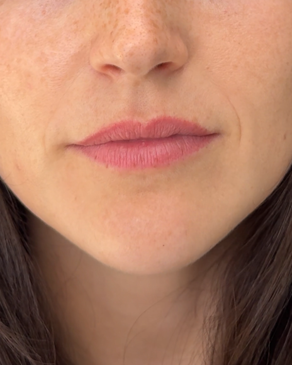 Before photo of Jessie Before Application