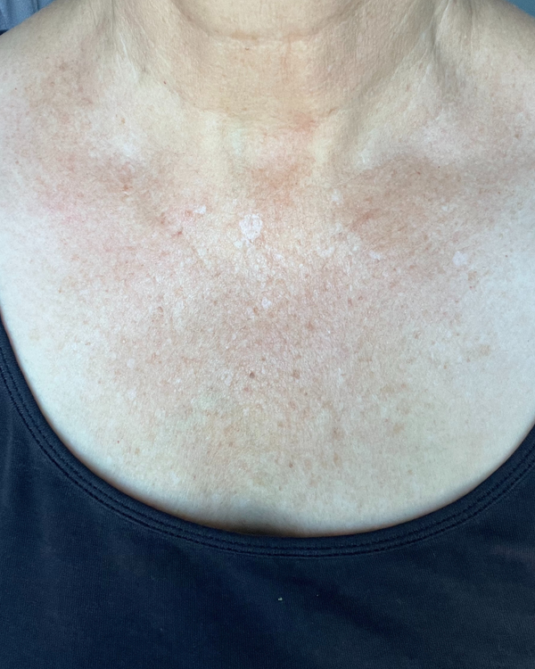 After photo of Louise W Week 2