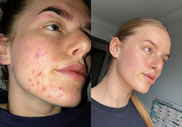 Before-and-after photo of a woman's face showing reduced acne scars after natural  skincare treatment