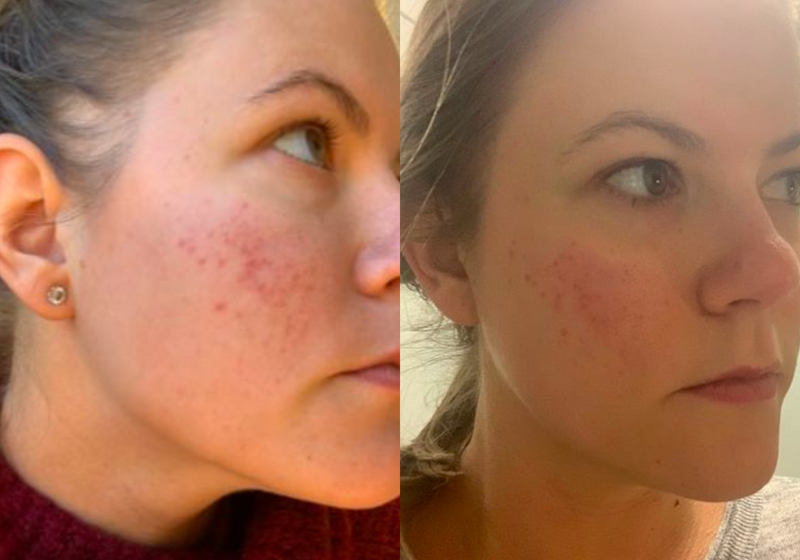 Before-and-after photo of a woman's face showing reduced acne scars after a organic skincare treatment